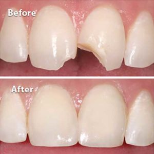 Before and after image of teeth