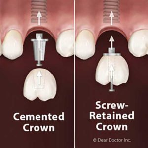 Cemented vs screw crown