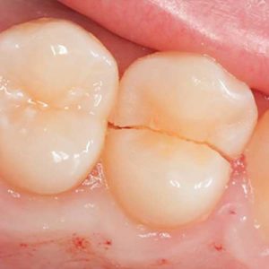 Image of cracked tooth