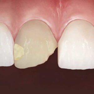Image of damaged teeth