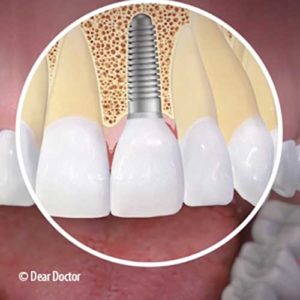 Image of Dental Implants