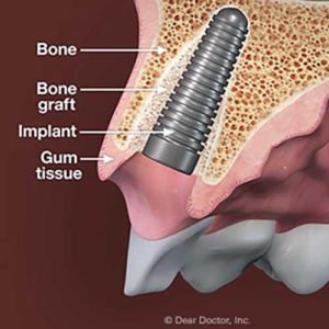 Procedure of Dental Implants