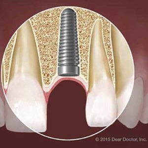 Image of teeth implant